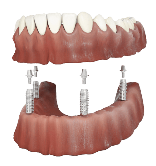 implant retained
