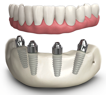 all-on-6-implants in forest hill and dulwich from london dental arts