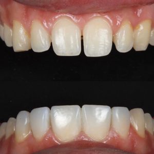 dental bonding surrey 2 - Copy - Copy