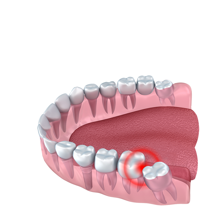 wisdom tooth extraction southall